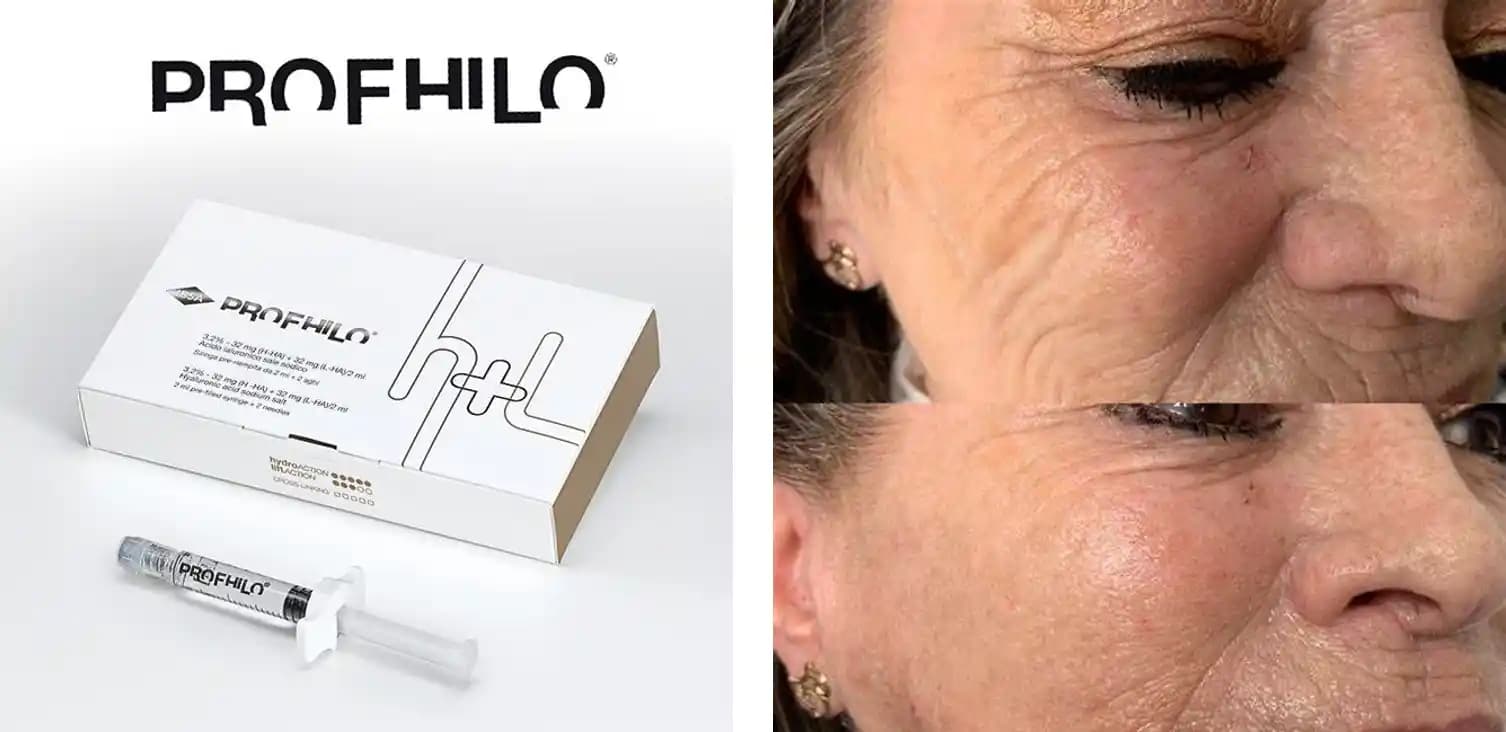 Profhilo ile Cilt Yenileme ve Gençleştirme: Yenilikçi Hyaluronik Asit Uygulaması